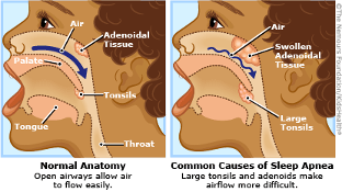 <p>Anatomical Differences in Pediatric Airway Related to Sleep Apnea