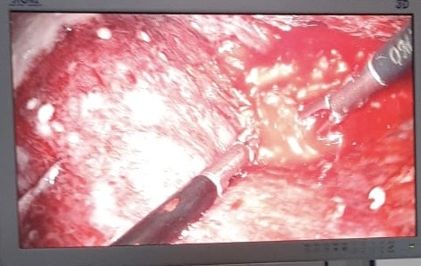 <p>Empyema Seen During Video-Assisted Thoracoscopic Surgery