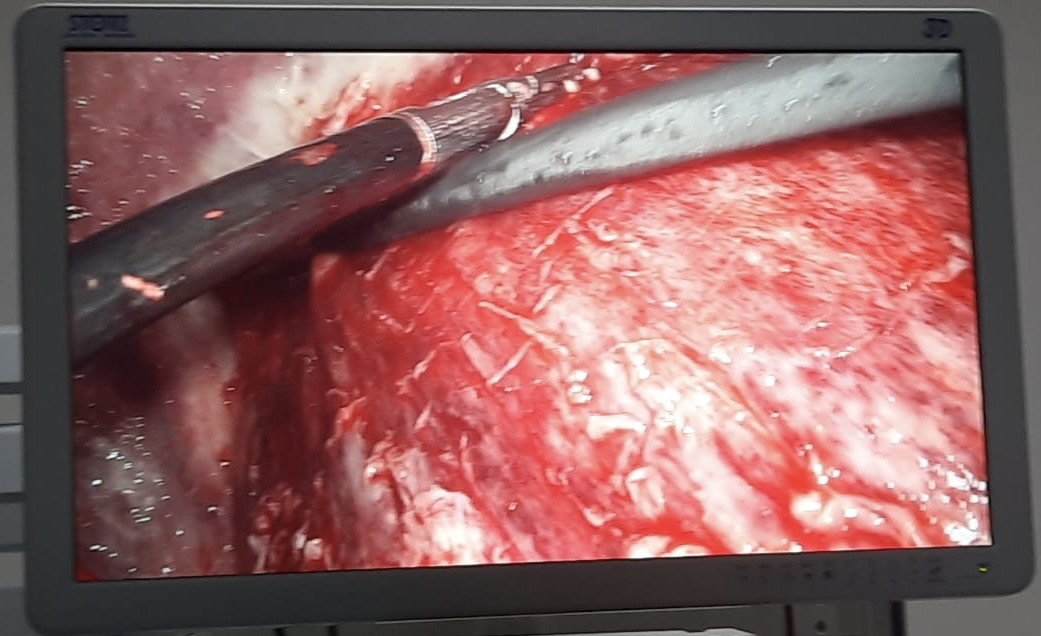 <p>Thickened Pleura Seen During Video-Assisted Thoracoscopic Surgery