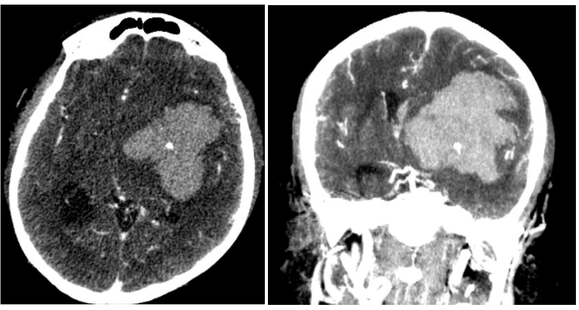 <p>Spot Sign, Computed Tomography Angiogram (CTA)