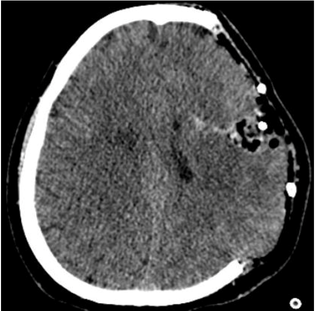 <p>Left Basal Ganglia Hematoma Evacuation, Postoperative Computed Tomography (CT)