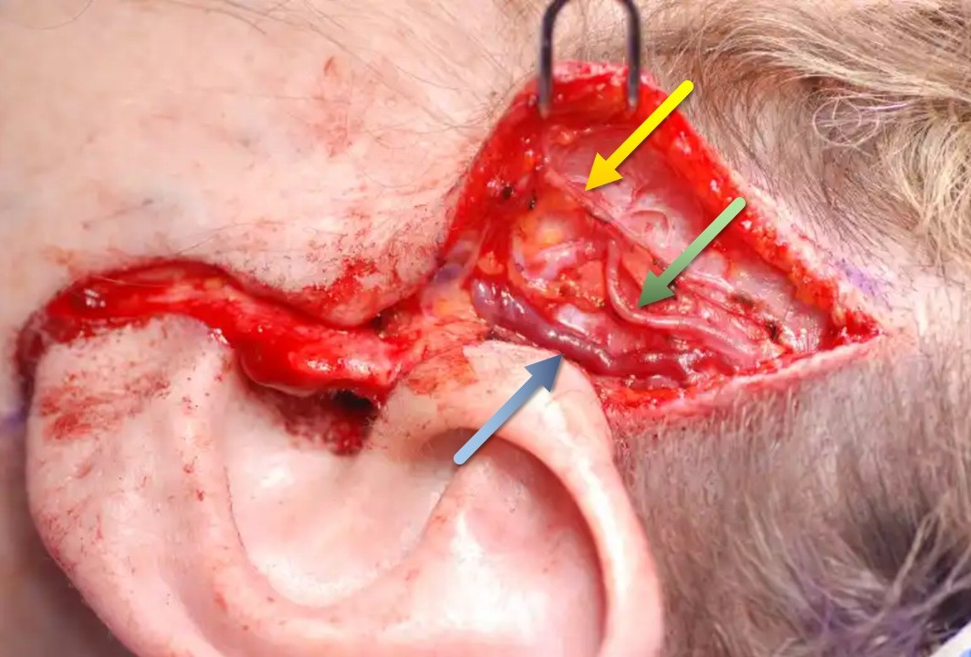 <p>Superficial Neurovascular Structures of the Temporal Region