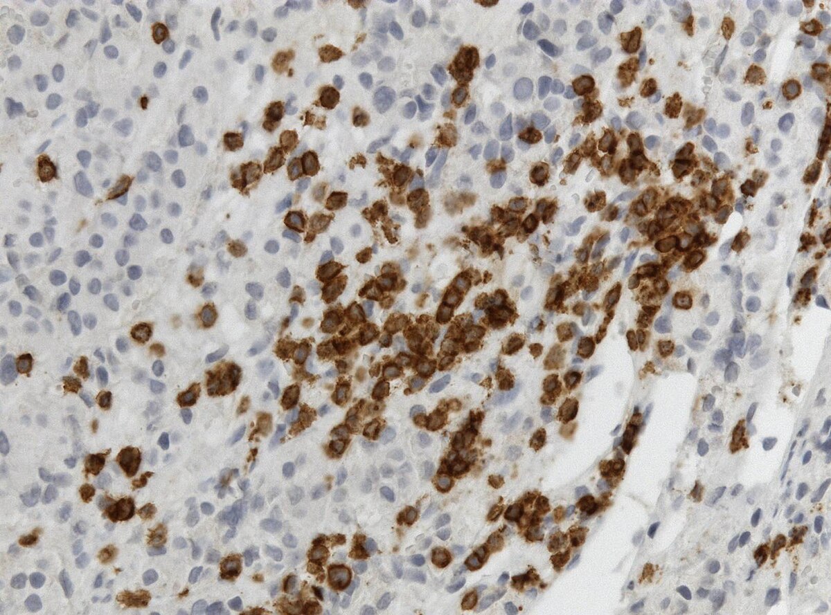 <p>Lymphocytic Hypophysitis. CD3 immunohistochemistry showing T cells (brown) in lymphocytic hypophysitis.</p>