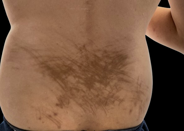 <p>Flagellate Erythema