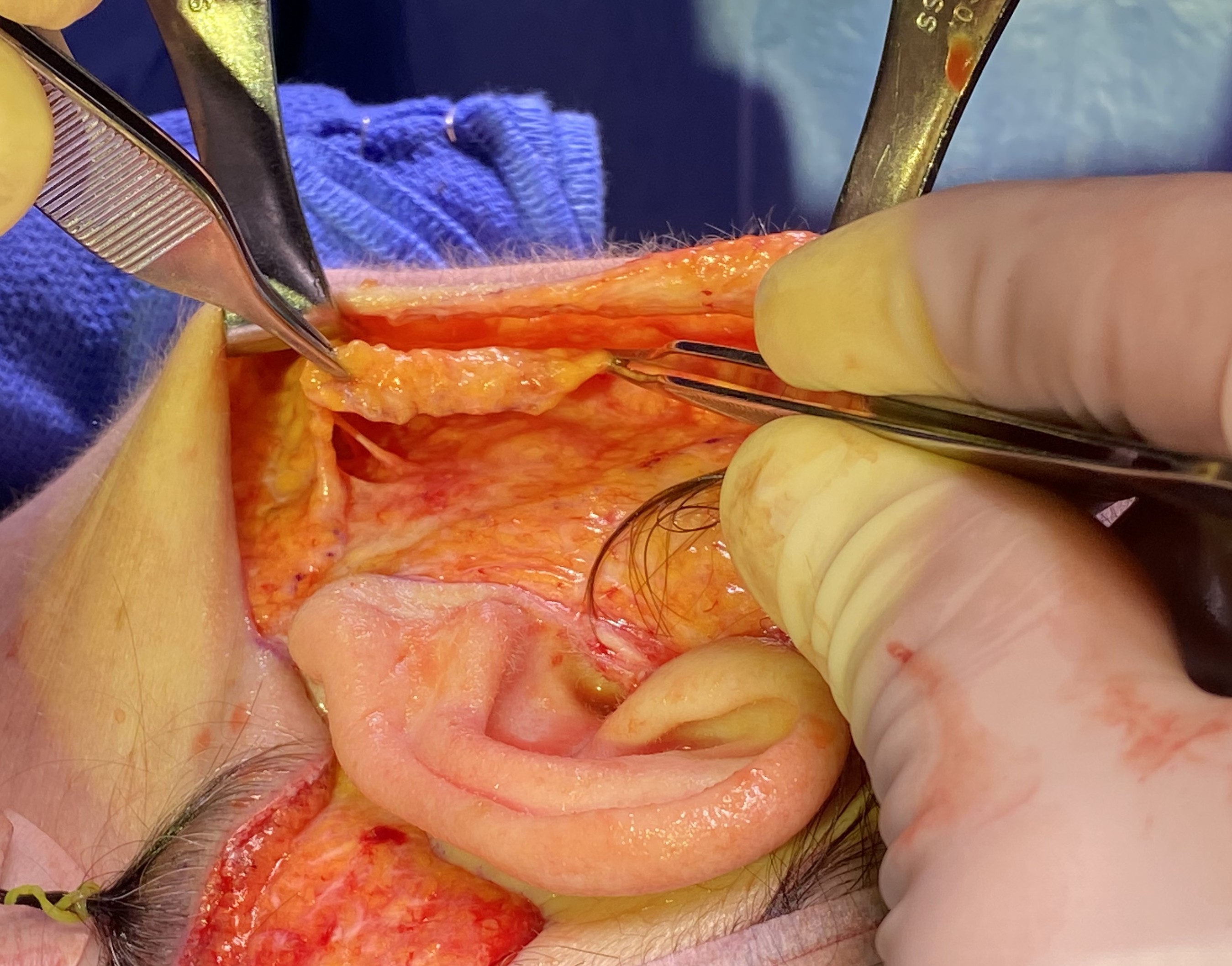<p>Superficial Musculoaponeurotic System Flap