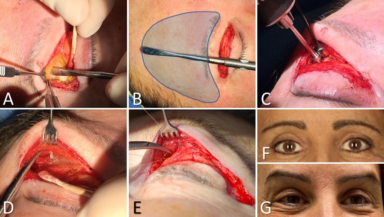 <p>Transblepharoplasty Brow Pexy