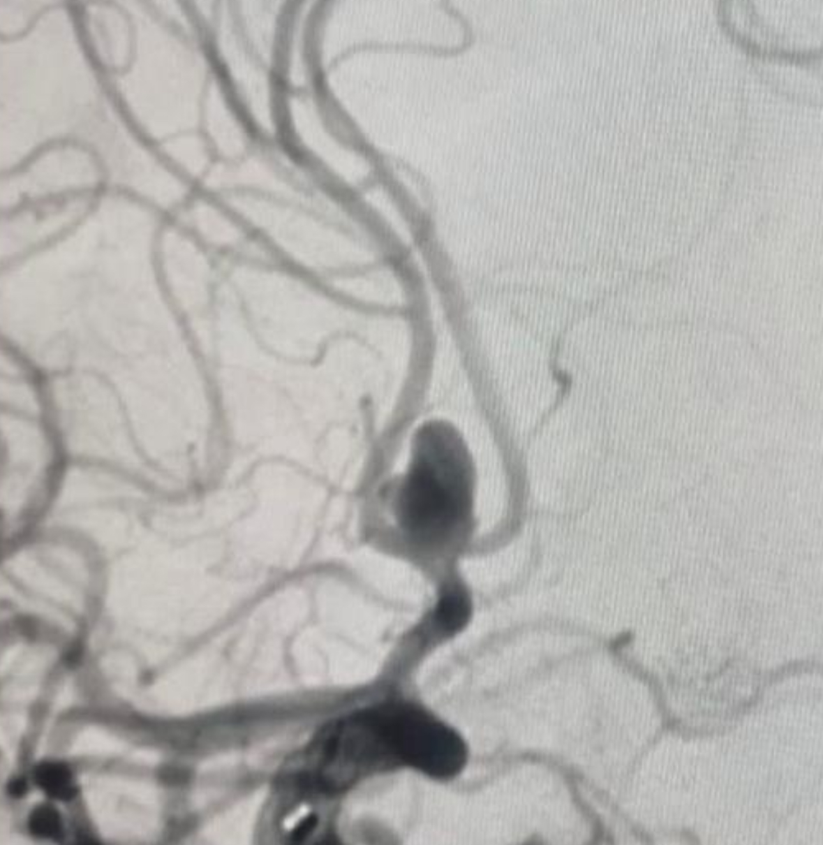 <p>Anterior Communicating Artery Aneurysm