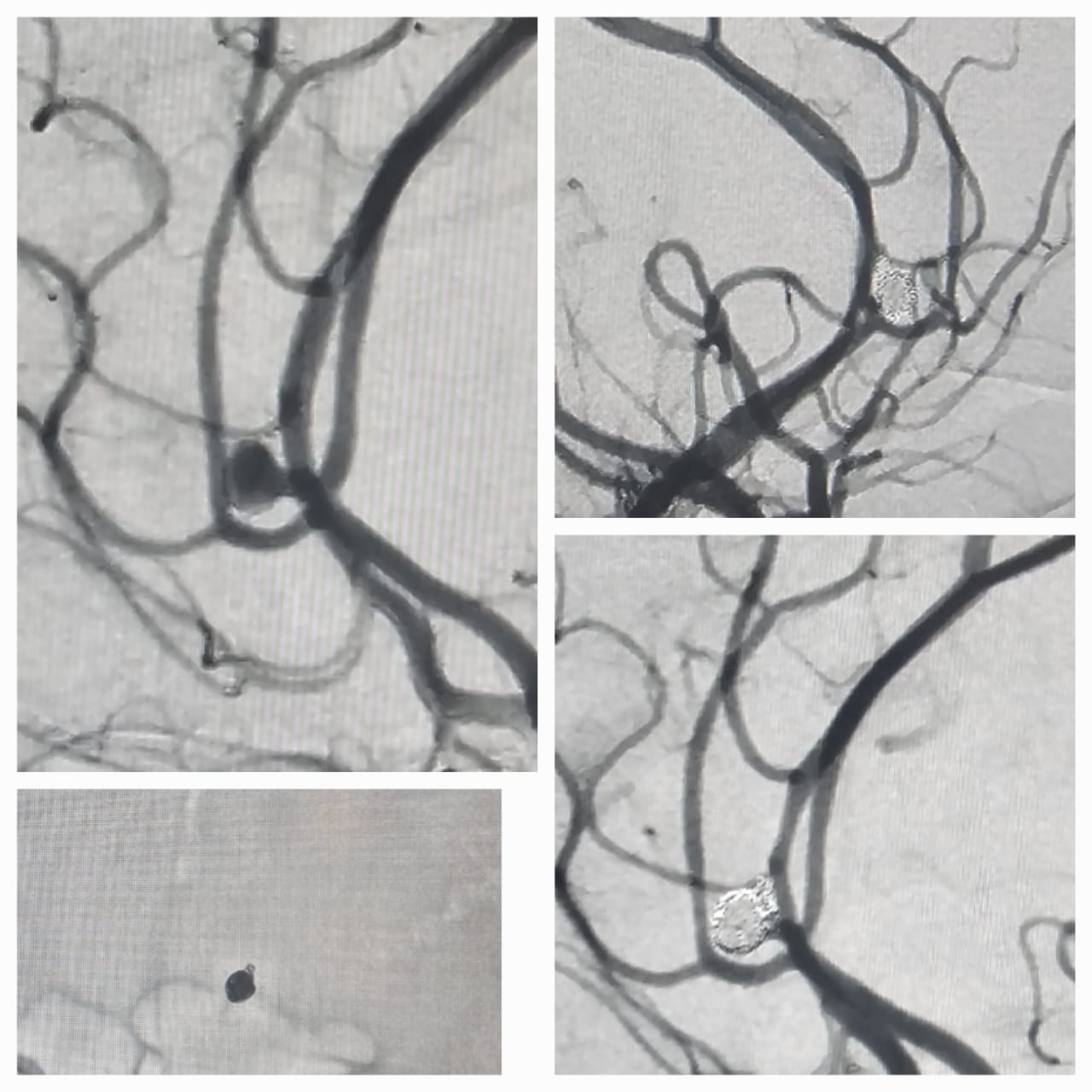 <p>Ruptured Saccular Anterior Communicating Artery Aneurysm