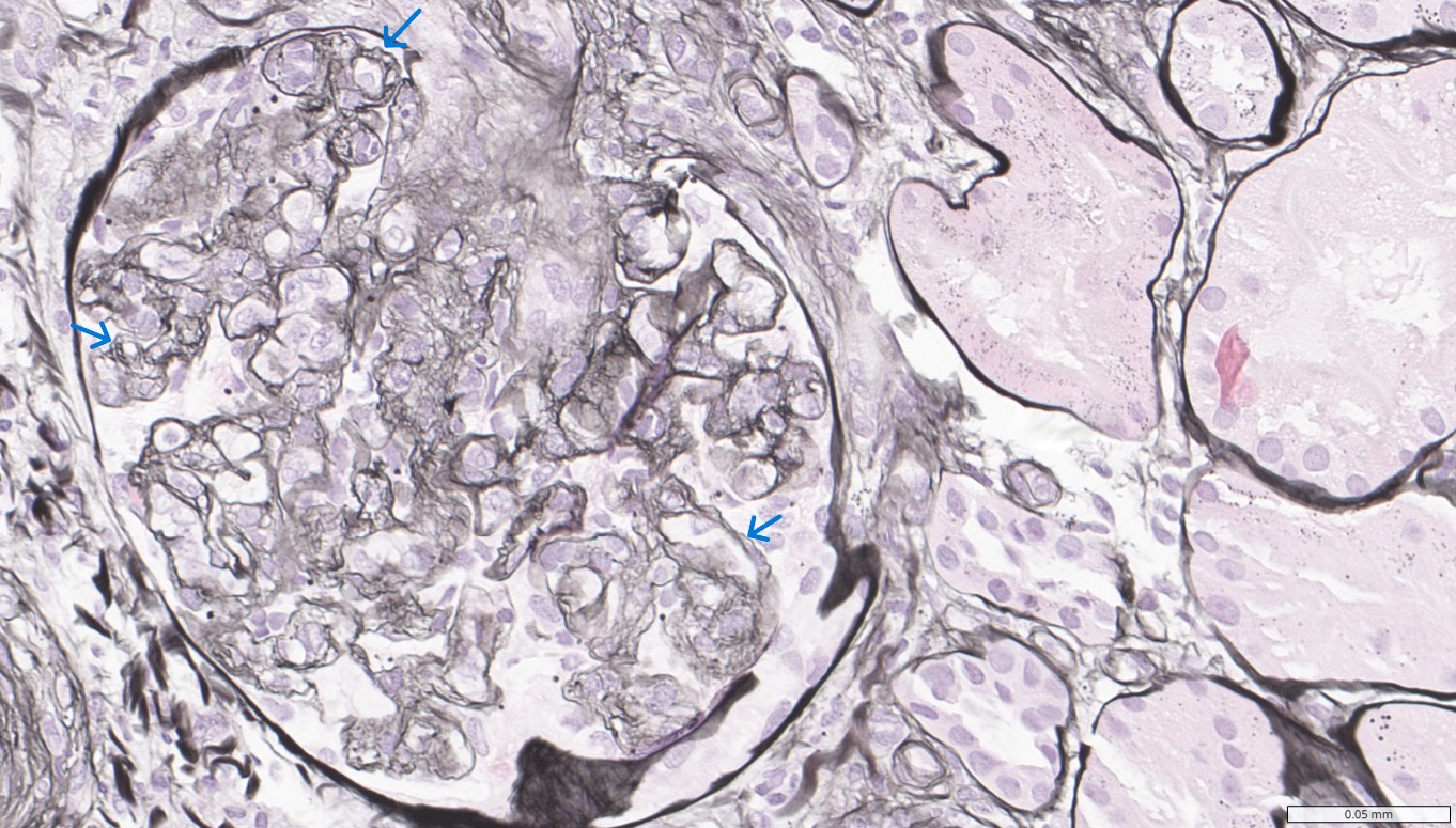 <p>Renal Allograft With Endothelial Injury