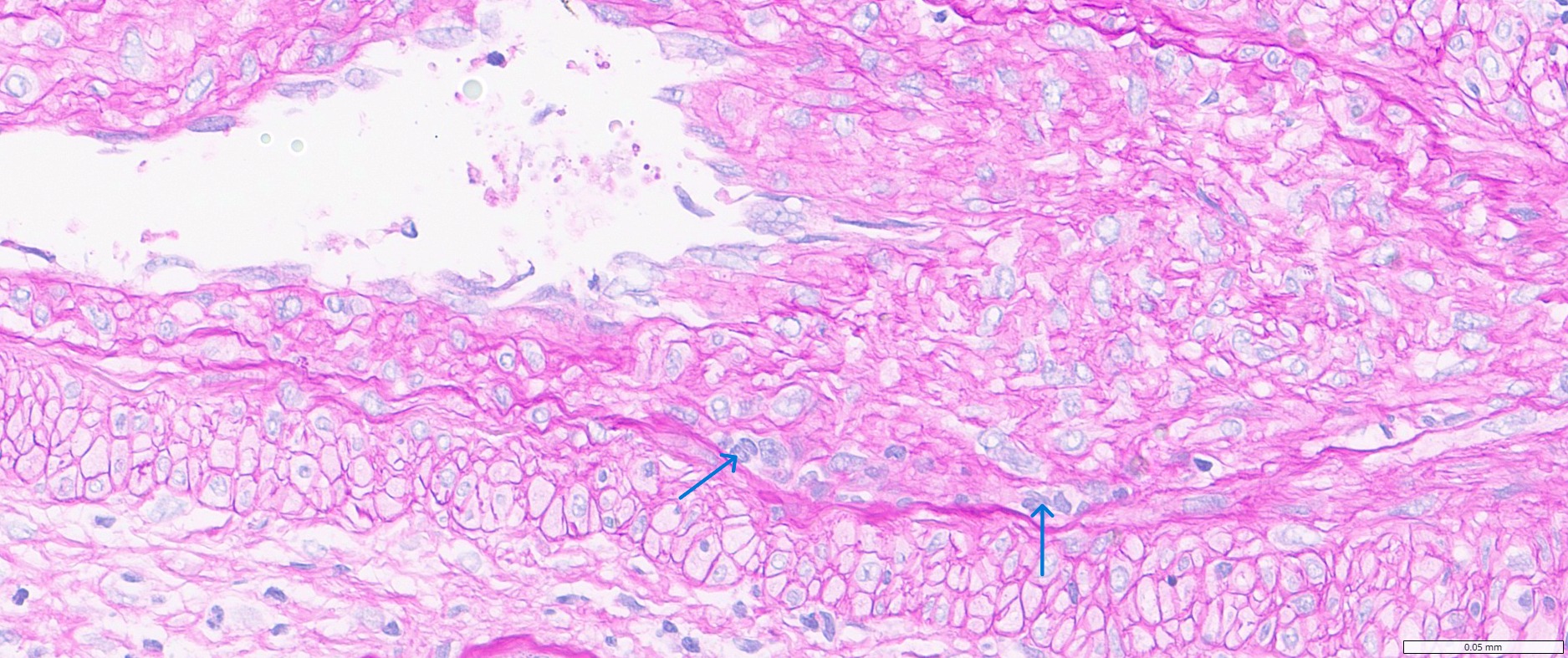 <p>Renal Allograft With Mononuclear Cells