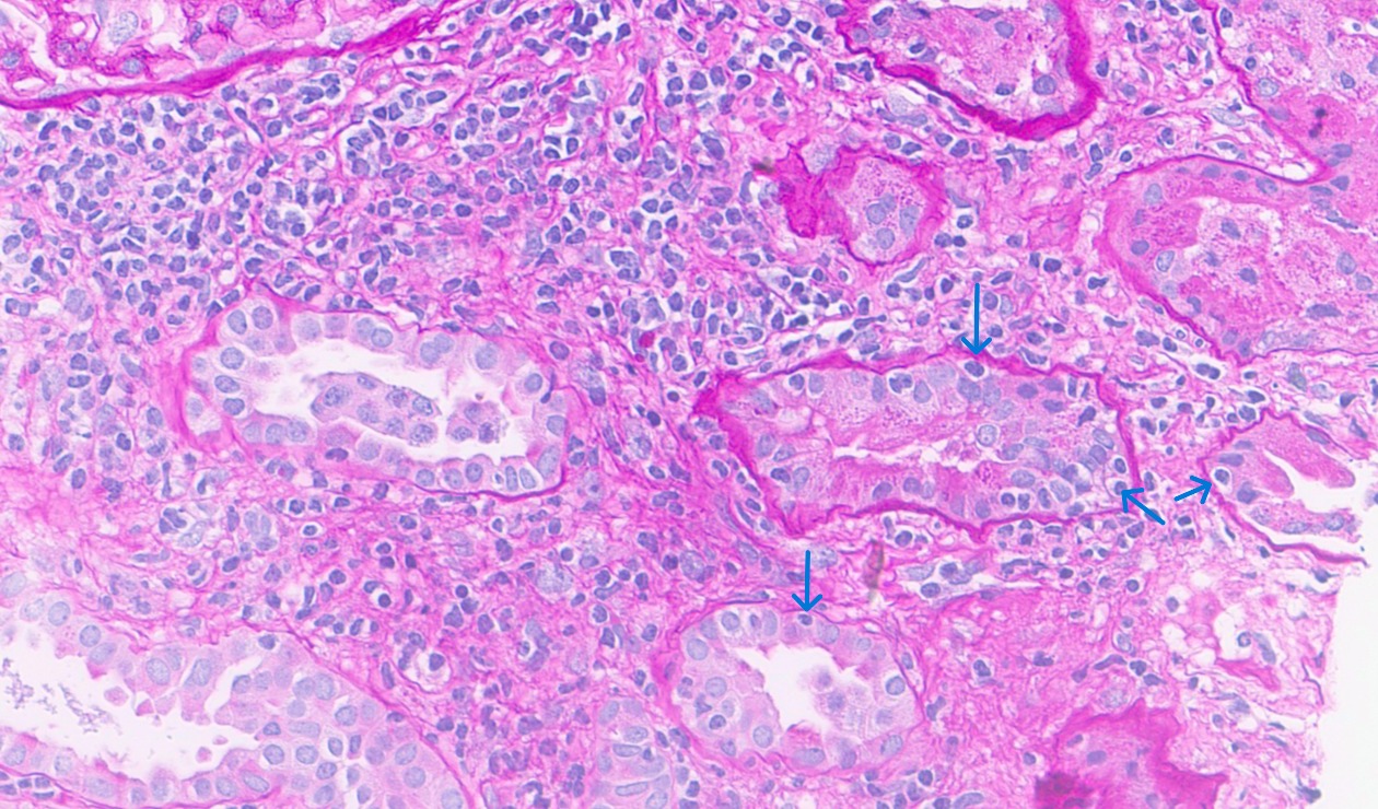 <p>Renal Allograft With Inflammatory Infiltrate