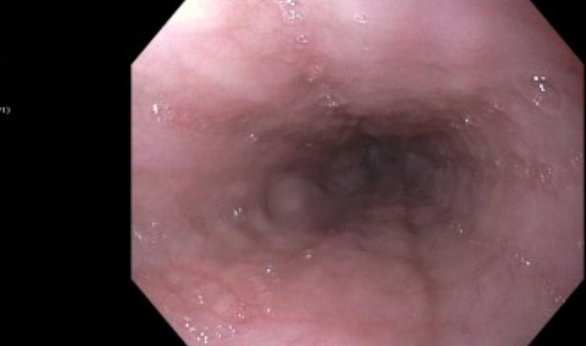 <p>Endoscopy of the Esophagus.&nbsp;Endoscopic image of the esophagus showing smooth, pale-pink mucosa.</p>