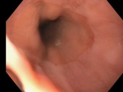 <p>Endoscopy of the Z-Line