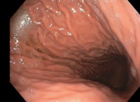 <p>Endoscopy of the Stomach