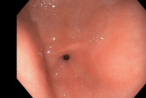 <p>Endoscopy of the Antrum
