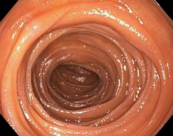 <p>Endoscopy of the Duodenum