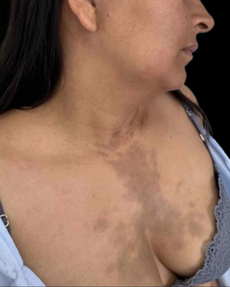 <p>Hydroxychloroquine-Induced Pigmentation