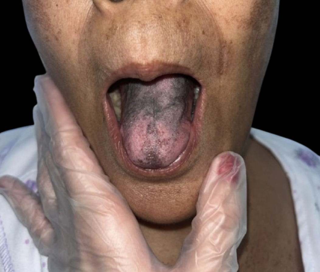 <p>Doxorubicin-Induced Mucosal Pigmentation