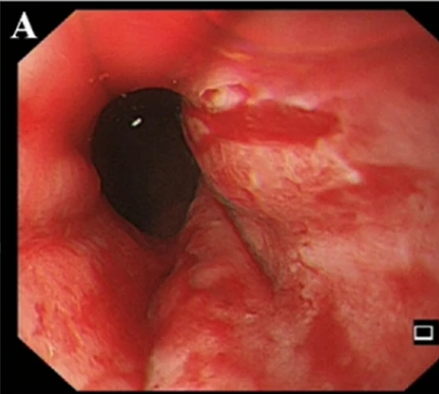 <p>Mallory-Weiss Syndrome on Esophagoscopy