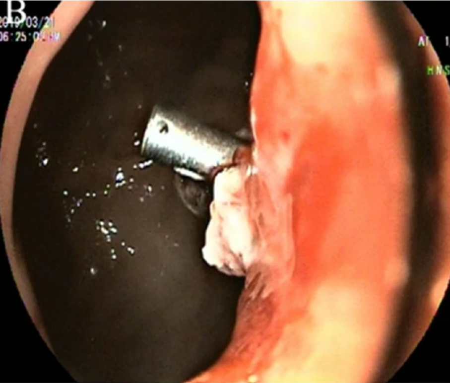 <p>Endoscopic View of Hemoclip Application for Bleeding Control