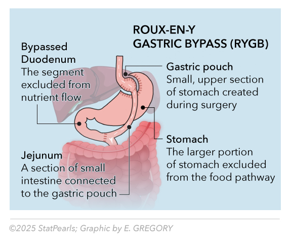<p>Roux-en-Y Gastric Bypass (RYGB)