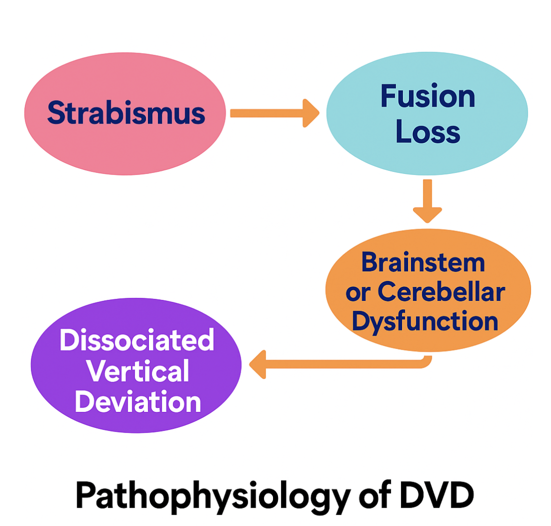 <p>Dissociated Vertical Deviation, Pathophysiology
