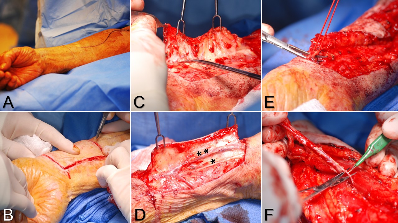 <p>Radial Forearm Flap Harvest