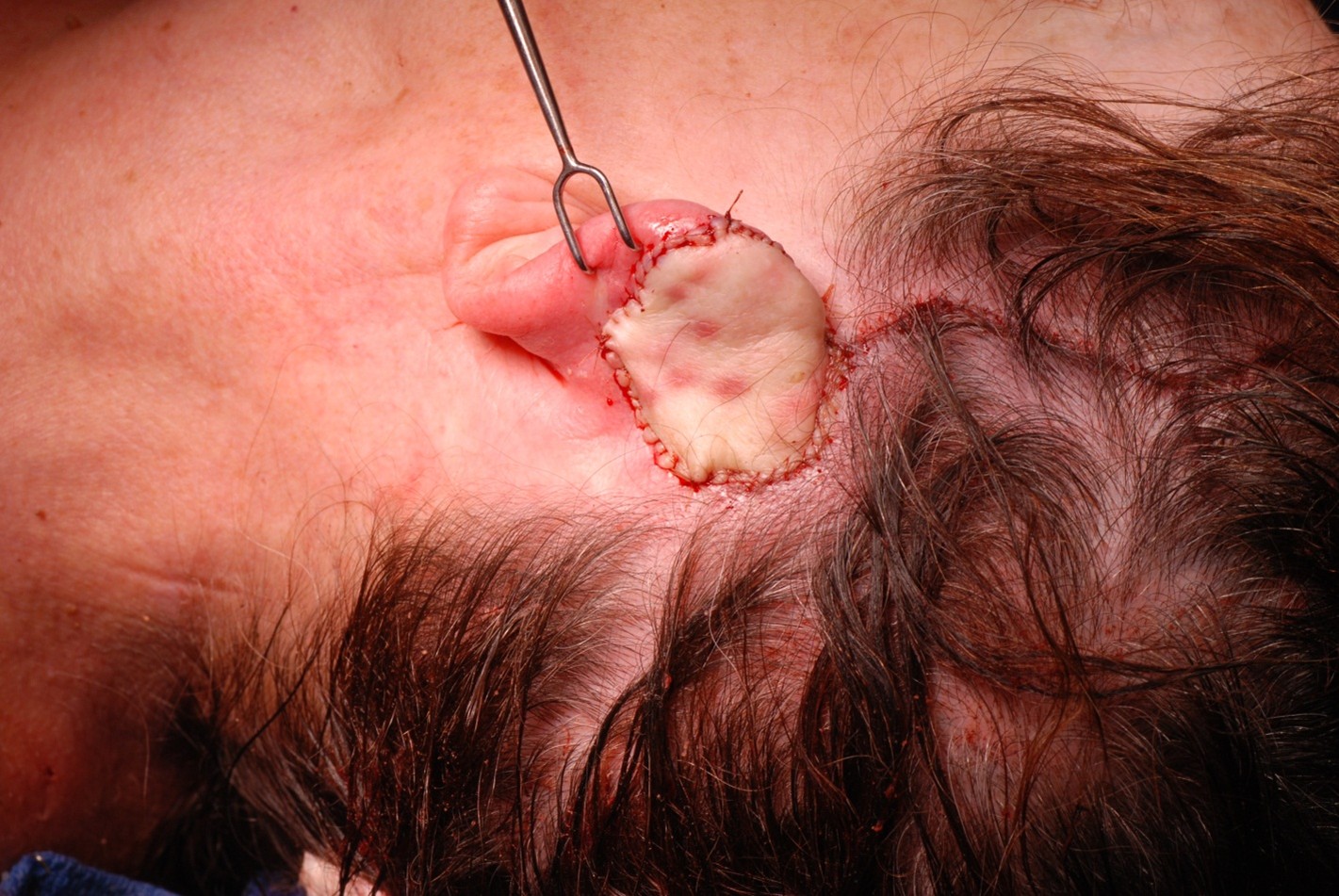 <p>Auricular Reconstruction with Temporoparietal Fascia Flap and Supraclavicular Full-Thickness Graft