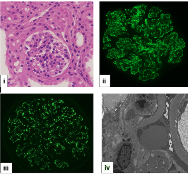 <p>Histopathology Showing Staphylococcal Infection-Associated Glomerulonephritis