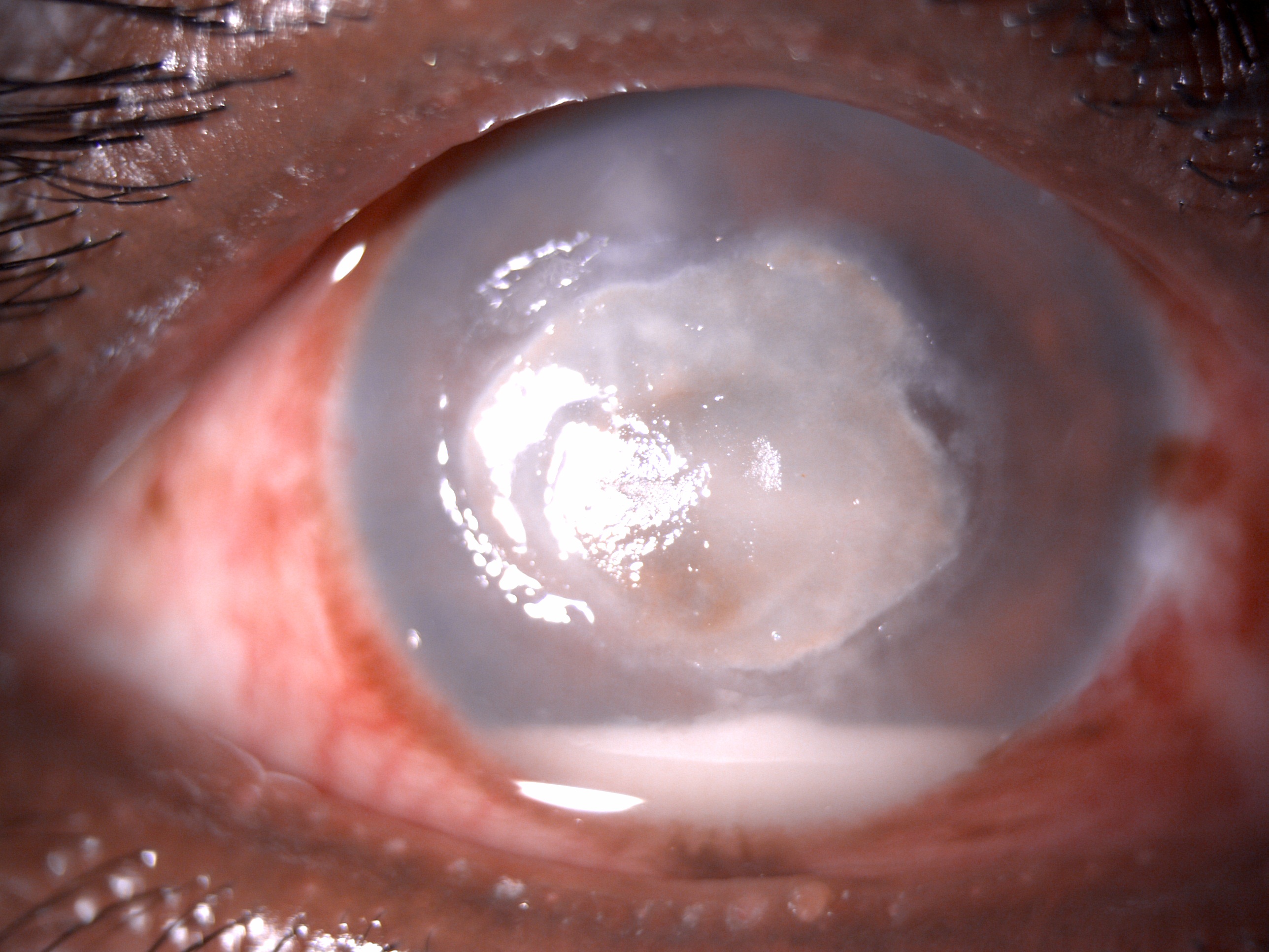 <p>Slit-Lamp Examination of&nbsp;<em>Pythium</em>&nbsp;Keratitis