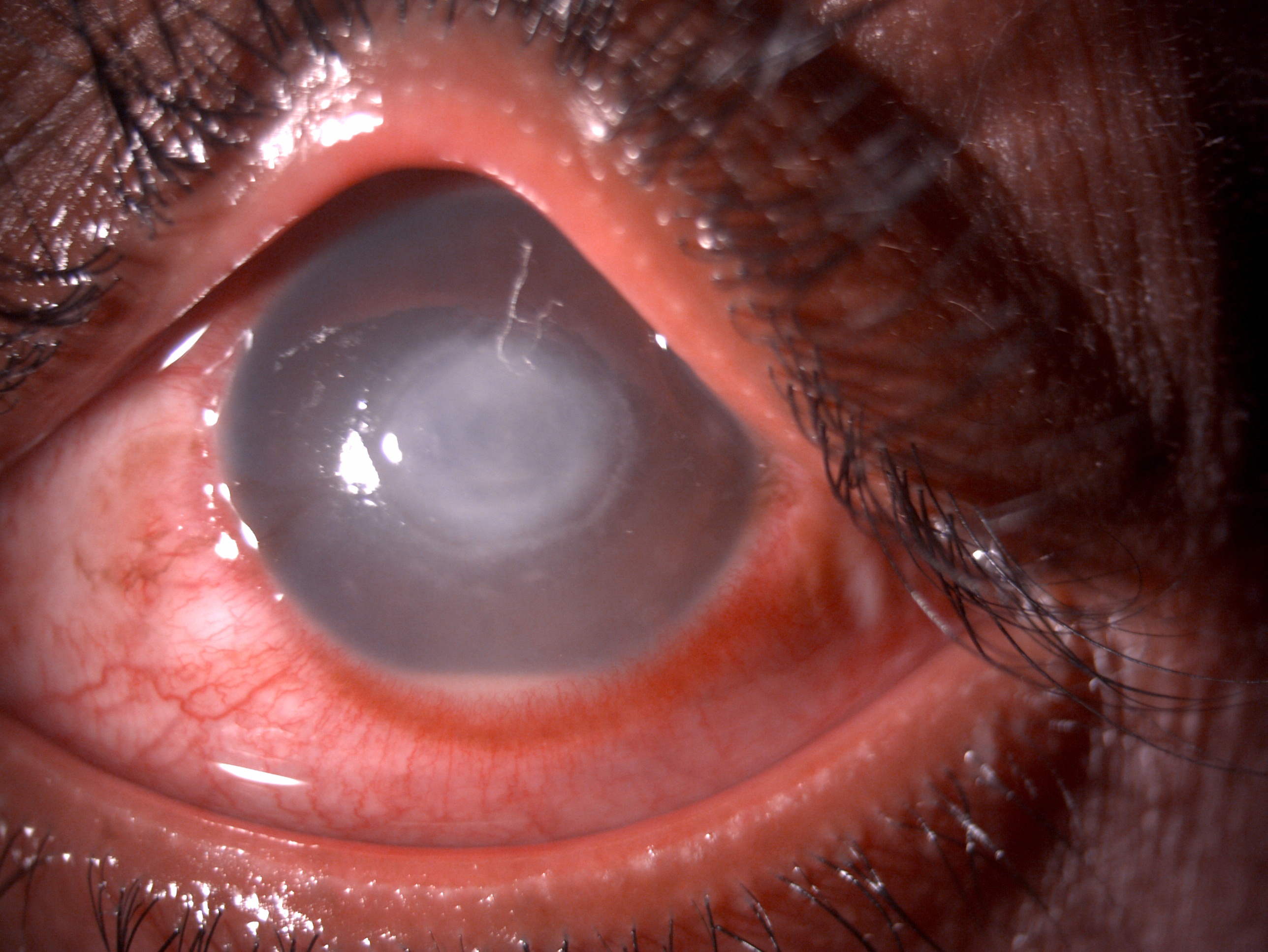 <p>Slit-Lamp Examination of Fungal Keratitis