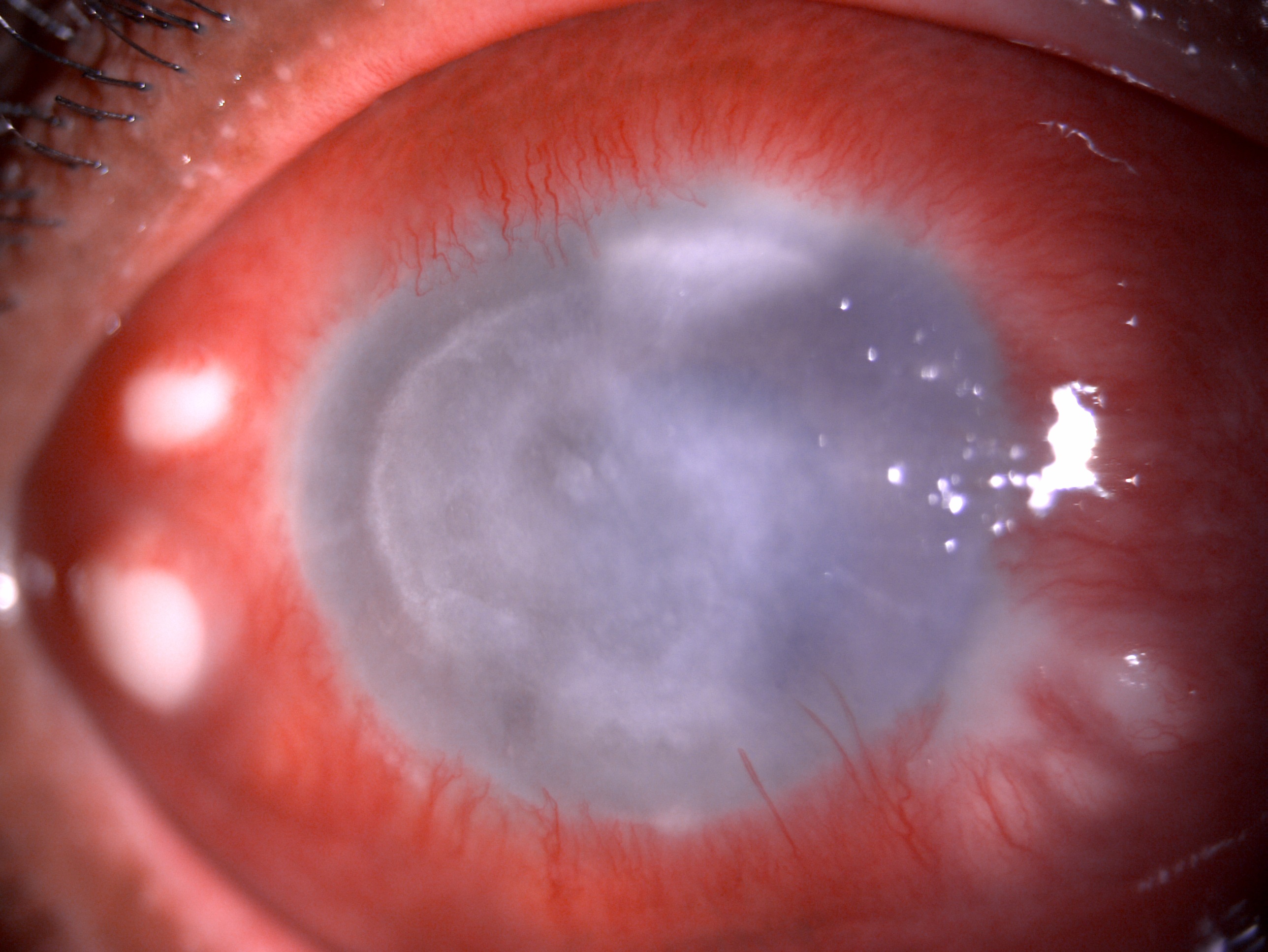 <p>Slit-Lamp Examination of <em>Acanthamoeba</em> Keratitis