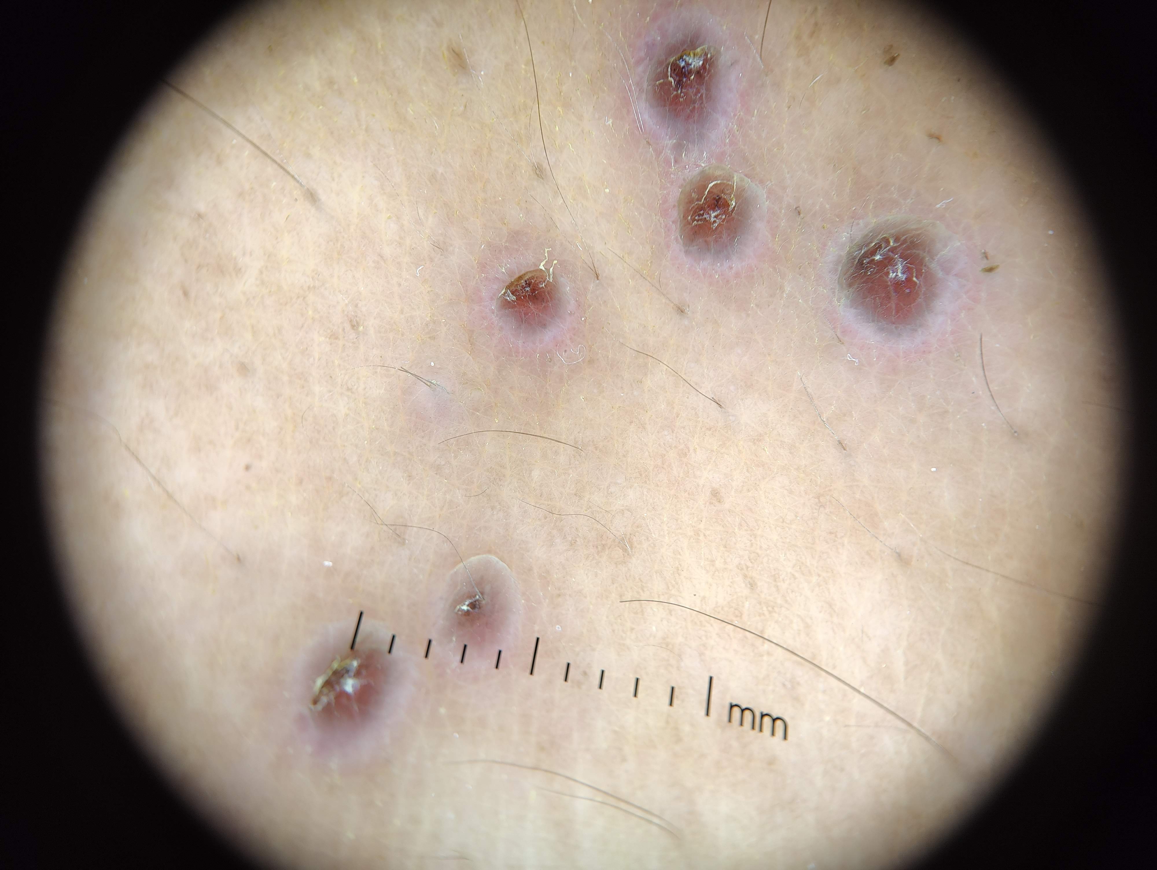 <p>Dermoscopic Halo Sign in Herpes Zoster