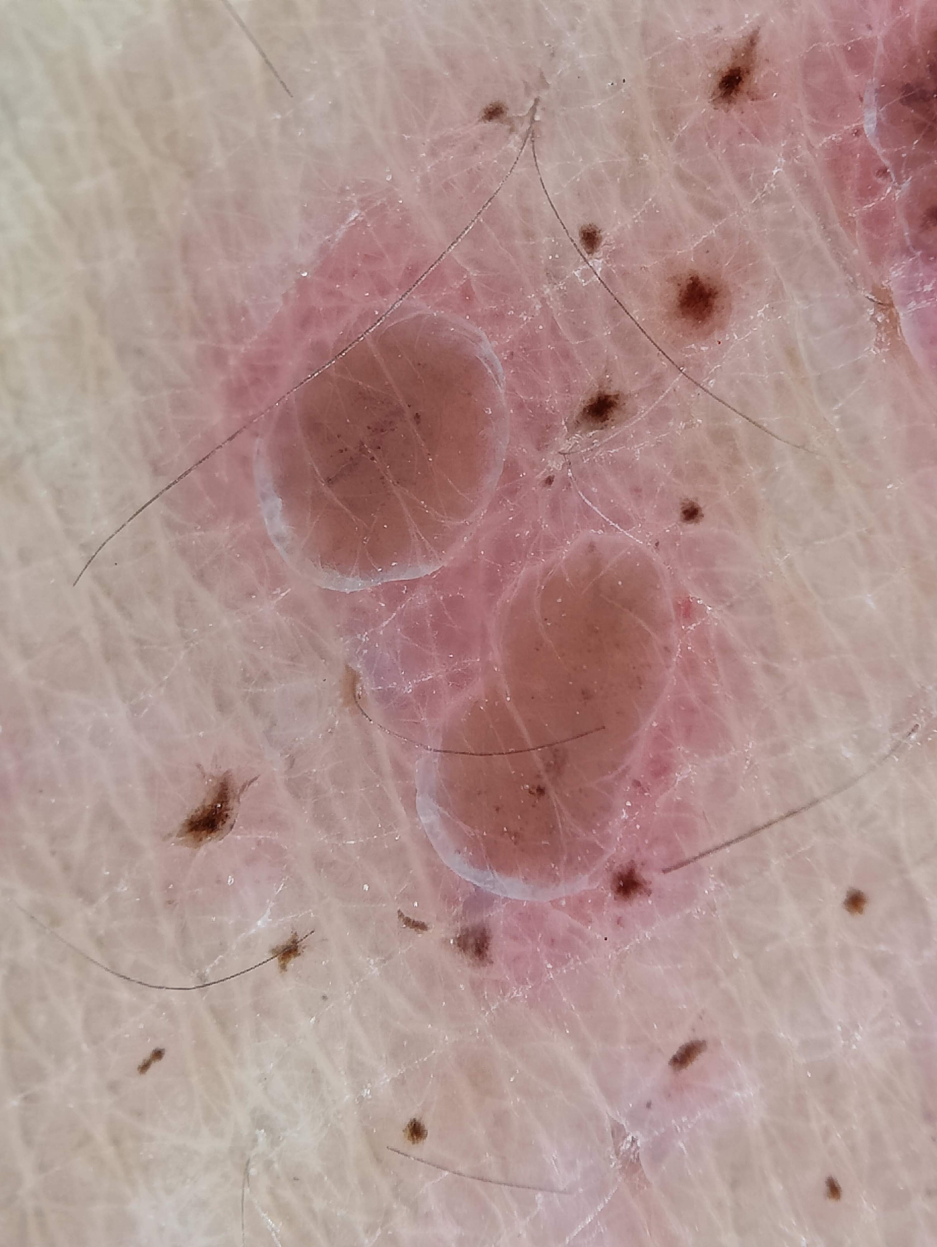 <p>Dermoscopic Vesicles in Herpes Zoster