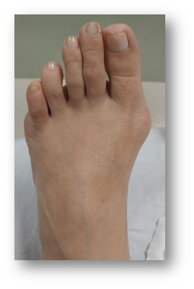 <p>Clinical Bunion Presentation