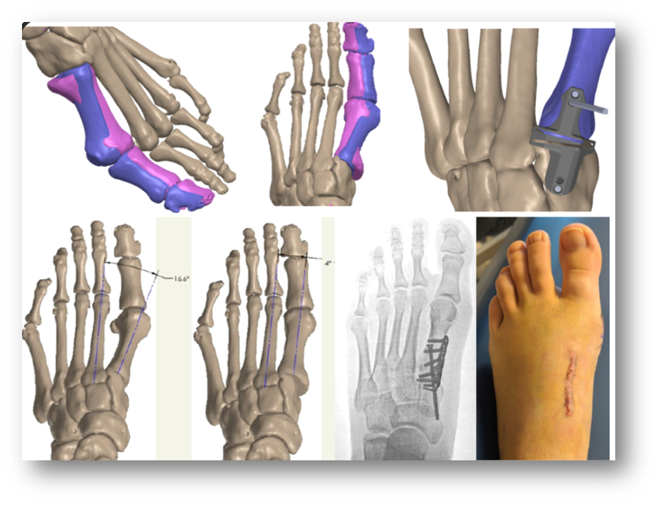<p>Patient-Specific Solution and Virtual Surgical Planning in Hallux Valgus