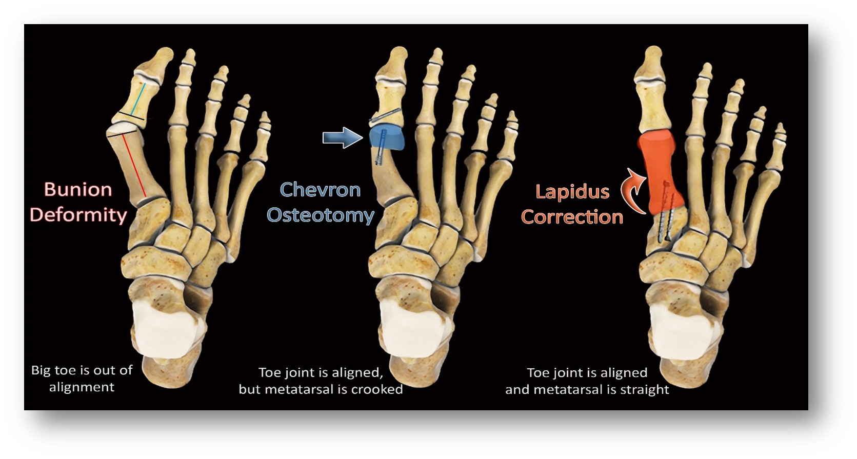 <p>Traditional Bunion Procedures