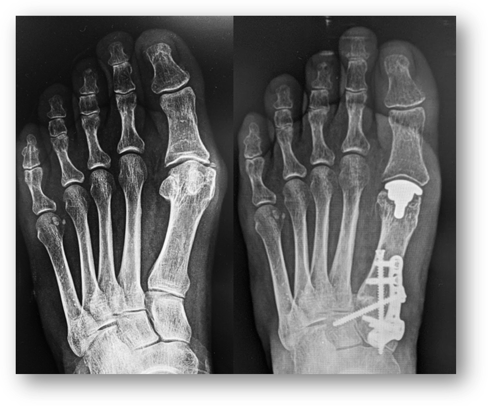 <p>Implant Arthroplasty of the Great Toe