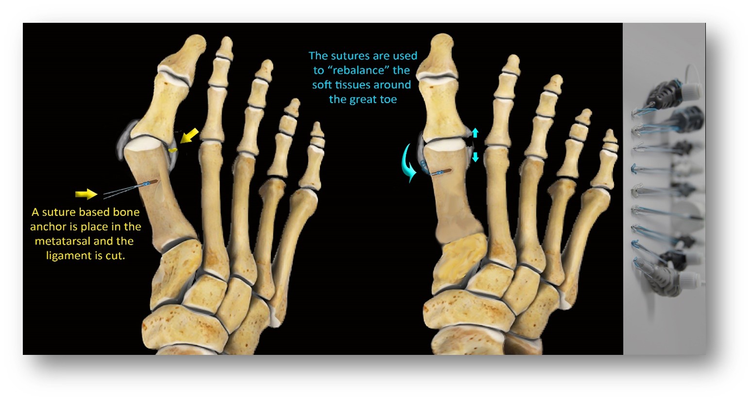 <p>Soft-Tissue Rebalancing of the Great Toe