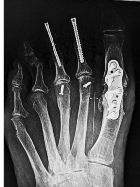 <p>Great Toe Joint Fusion&nbsp;in Hallux Valgus