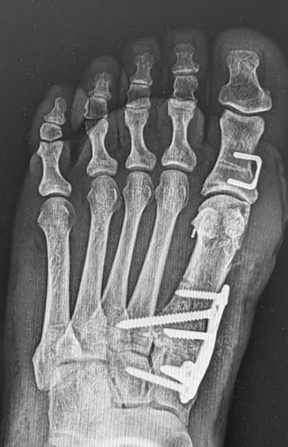 <p>Triplanar Lapidus Correction