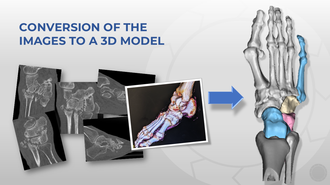 <p>Anatomic 3D Modeling of Foot Deformity