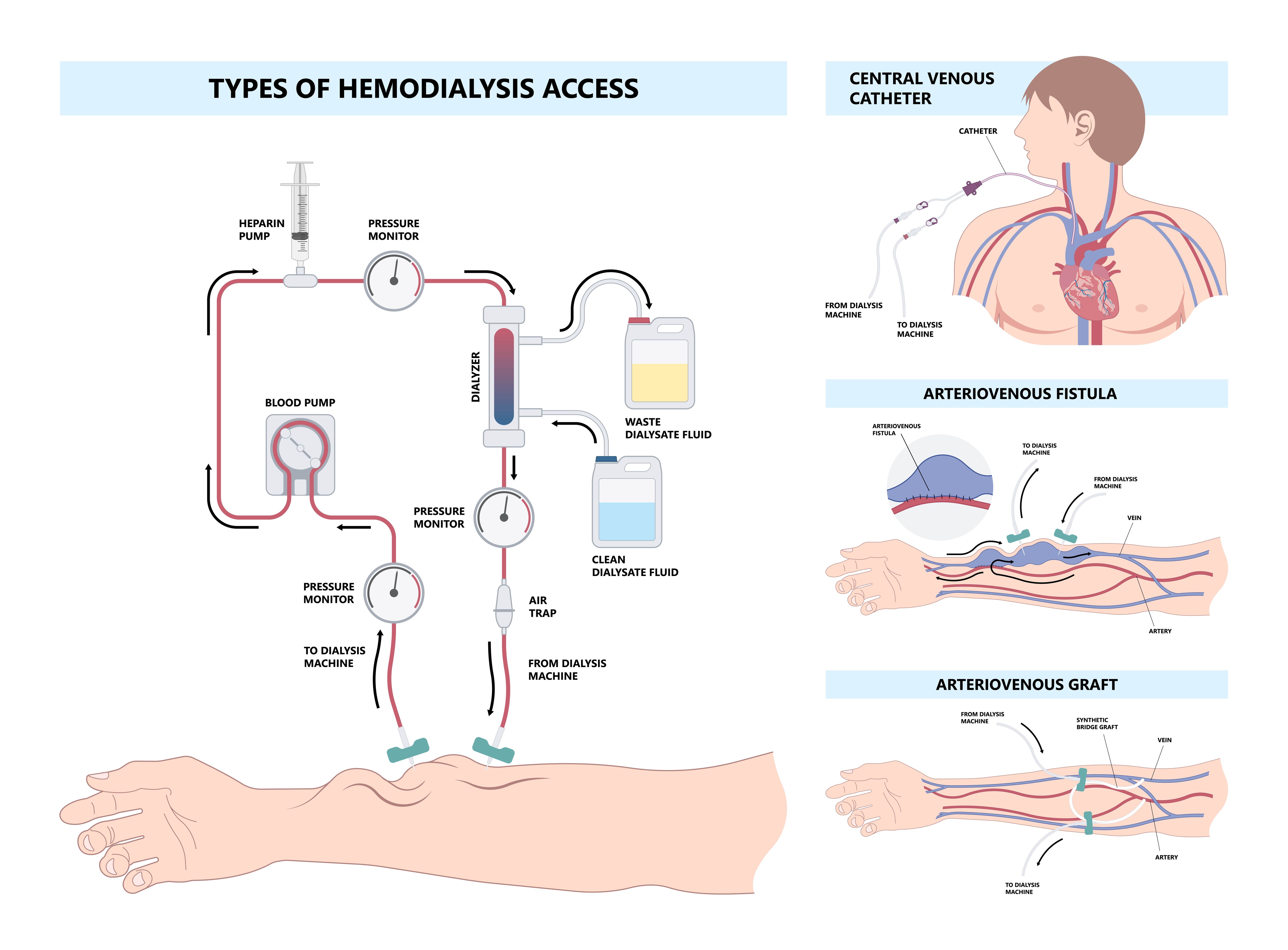 <p>Types of Hemodialysis Access