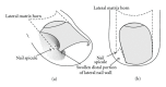 <p>Ingrown Toenail, Adolescent Type