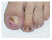 <p>Lateral Ingrown Toenail With Granulation