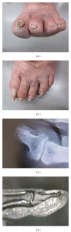 <p>Pincer Nails in a Female Patient