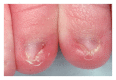 <p>Neonatal Ingrown Nails.</p>