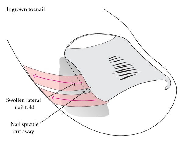 <p>Schematic illustration of Taping.</p>