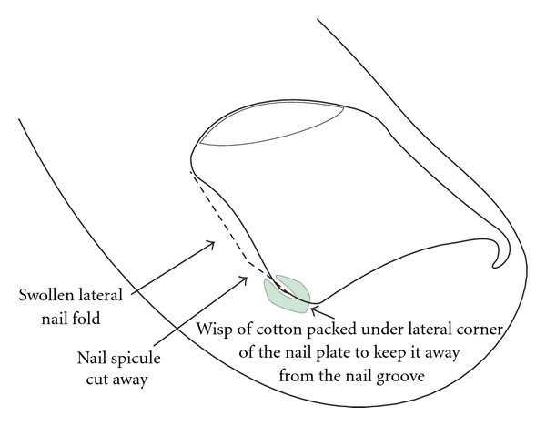 <p>Ingrown Toenail, Packing.</p>