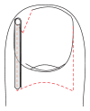 <p>Ingrown Toenail, Gutter Treatment.</p>